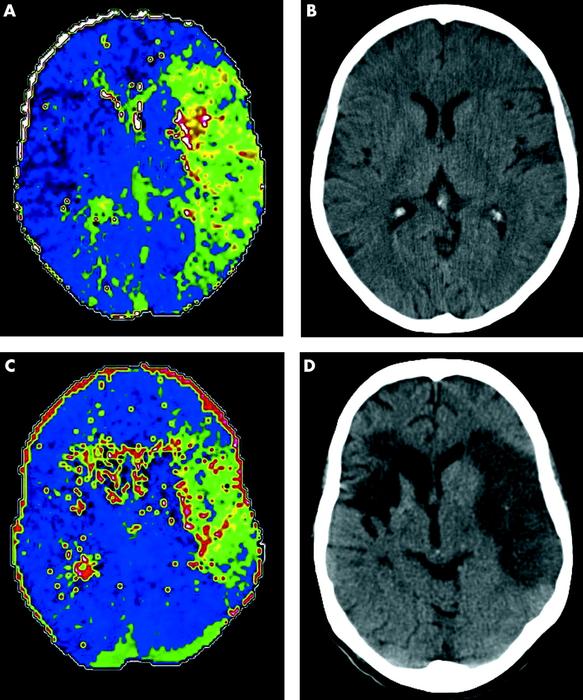 (A) Perfusion CT (time to peak (TTP) map) of acute left MCA ischaemia sub-three hours and (B) equivalent non-contrast CT. Perfusion CT predicts final infarct volume in the absence of arterial recanalisation: (C) three hour TTP map and (D) 24 hour non-contrast CT