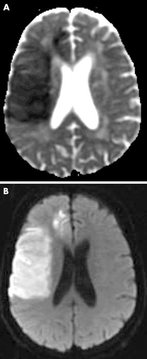 Apparent diffusion coefficient (ADC) map and diffusion weighted MRI (DWI) of subacute stroke (day 3). Restricted diffusion of water leads to decreased signal on ADC, increased signal on DWI