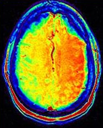 Imagen de etiquetado de espín arterial de IRM en que se observa la hipoperfusión de gran extensión en el hemisferio cerebral derecho. Existe una discordancia clara entre difusión y perfusión