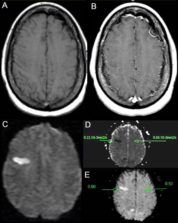 (A) Imagem por ressonância magnética nuclear (RNM) ponderada em T1 sem contraste. (B) IRM ponderada em T1 pós-contraste mostrando aumento mínimo nos vasos leptomeníngeos sobre a região frontal direita. (C) Imagem ponderada por difusão (IPD) mostrando uma área hiperintensa na região frontal direita. (D) Mapa de coeficiente de difusão aparente (CDA) mostra lesão hipointensa, indicando difusão restrita que se correlaciona com uma alta intensidade na IPD e difusão exponencial. (E) O valor de ADC é 0.22 x 10³ mm²/segundo, correspondendo a um infarto hiperagudo