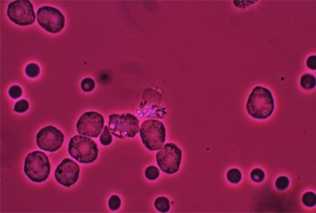 Calcium pyrophosphate crystals under compensated polarising light microscopy