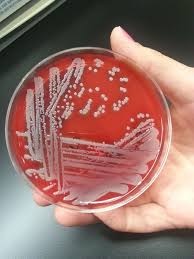 Septic arthritis images