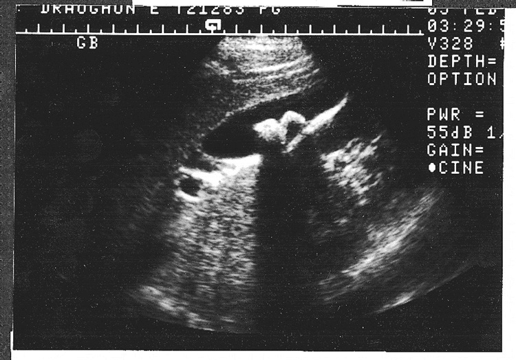 Transabdominal ultrasound revealing gallstones (with characteristic acoustic shadowing) in a patient with acute pancreatitis)