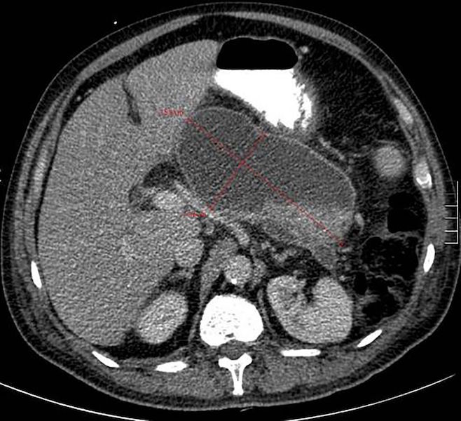 Walled off pancreatic necrosis