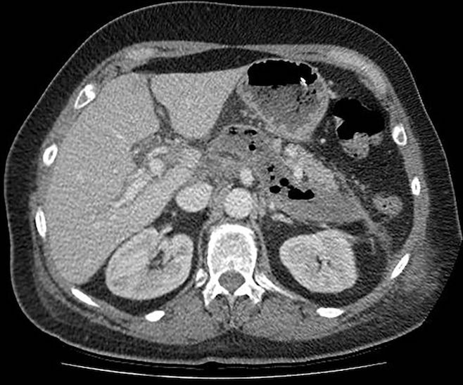 Infected necrotic collection, not fully encapsulated, on day 20 after disease onset