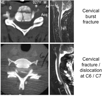 Common fracture patterns with severe cervical spine trauma. Top row: cervical burst fracture at C5 level. Top left: axial CT image showing a fracture of C5 vertebral body. Top right: mid-sagittal T2-weighted MRI showing retropulsion of the body of C5 with spinal cord compression, T2-weighted signal changes within the spinal cord, and T2-weighted signal changes within the posterior ligamentous complex indicating disruption of these ligaments. Bottom row: fracture dislocation C6-C7 level. Bottom left: axial CT through C6/C7 facet level. Bottom right: T2-weighted mid-sagittal MRI demonstrating spinal cord compression and T2-weighted signal change within the spinal cord