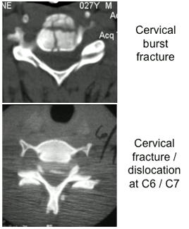 Common fracture patterns with severe cervical spine trauma. Top: axial CT image showing a cervical burst fracture at C5 level. Bottom: axial CT showing fracture dislocation at C6-C7 level.