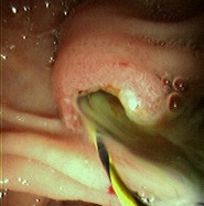 Foto endoscópica do mesmo paciente após remoção de grande cálculo do ducto colédoco; drenagem abundante de pus através da ampola