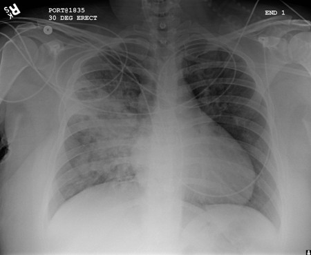 Increased opacification of the right perihilar region and superior segment of the right lower and upper lobes consistent with worsening aspiration pneumonia