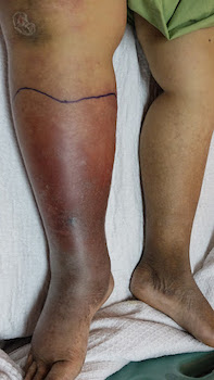 Drawing around the edge of the infection