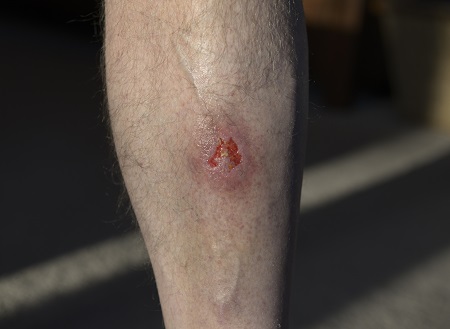 Cellulitis and erysipelas images