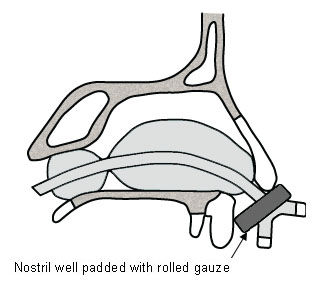 Double-balloon nasal catheter in place