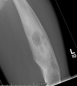 Osteomyelitis images