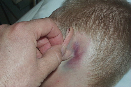 Battle's sign: superficial ecchymosis over the mastoid process