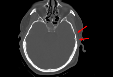 Skull fractures images