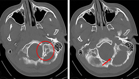 Occipital fracture extending to foramen magnum: risk of brainstem compression by haematoma