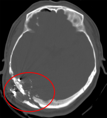 Gunshot wound with comminuted elevated fracture and pneumocephalus