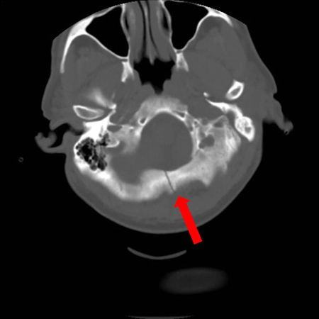 Axial CT scan showing non-depressed linear skull fracture (arrow) of the skull base involving the foramen magnum. This injury pattern is concerning for associated spinal fracture, cord injury, and blunt cerebrovascular injury