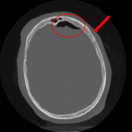 Axial CT scan demonstrating an open non-depressed linear skull fracture (arrow) associated with pneumocephalus (circle)
