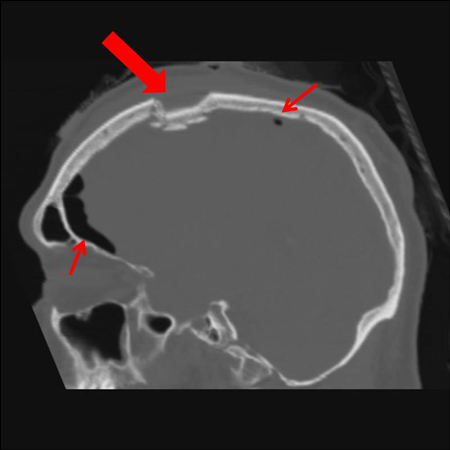 Sagittal CT images of an open, comminuted, depressed skull fracture. Note the associated pneumocephalus (small arrows). The level of depression is greater than the bony table and there are a number of bone fragments impacted below the inner cortex of the opposing bone (large arrow). Despite lack of underlying associated brain injury, this fracture required operative debridement and elevation of the bone fragments. See also the corresponding coronal CT image