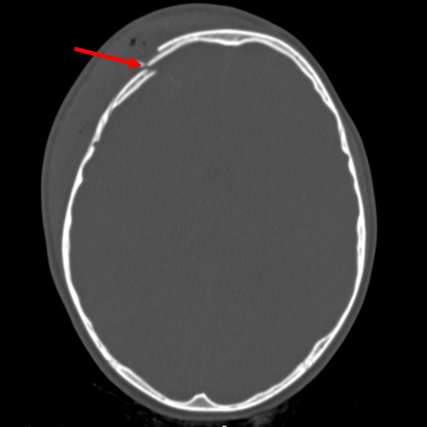 Depressed skull fracture: level of depression equal to thickness of cortex