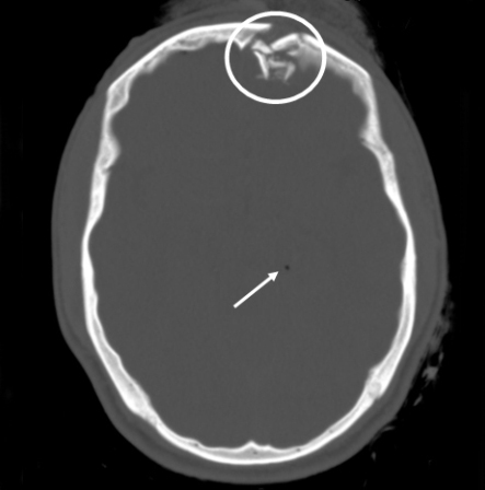 Comminuted depressed skull fracture with pneumocephalus