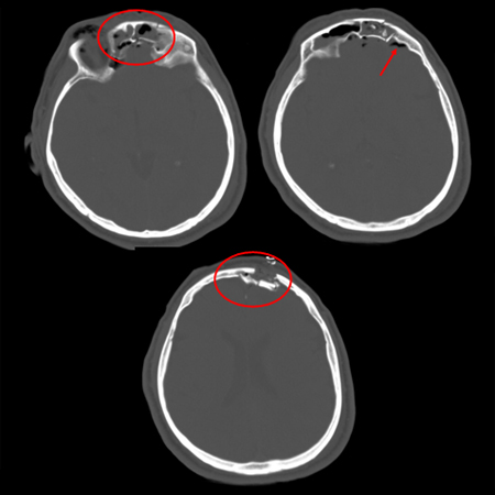 Comminuted depressed fracture of the frontal sinus with air, fluid, and bone fragments in frontal sinus and pneumocephalus; level of depression greater than width of cortex