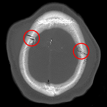 Transcranial gunshot wound