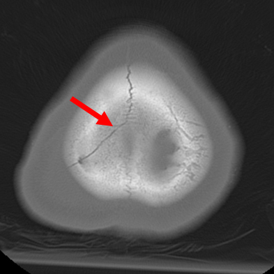 Linear parietal fracture without depression
