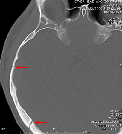 Fracture of temporal bone