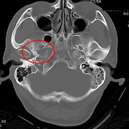 Fracture of temporal bone extending into foramen ovale