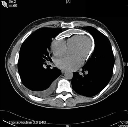Chest CT showing a double layer of pericardial calcification in a 56-year-old male patient with idiopathic calcific constrictive pericarditis