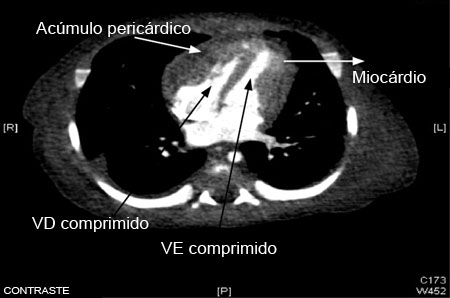 Tomografia computadorizada (TC) do tórax em um bebê com pericardite purulenta, mostrando uma coleção pericárdica com compressão dos ventrículos esquerdo (VE) e direito (VD)