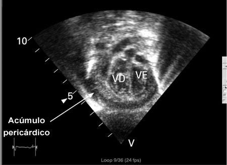 Ecocardiografia em um bebê com pericardite purulenta, mostrando uma coleção pericárdica. VE = ventrículo esquerdo, VD = ventrículo direito