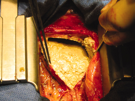 Pericardiectomia em paciente do sexo masculino de 56 anos com pericardite constritiva calcificada idiopática. O pericárdio está espessado e calcificado