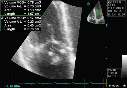 A transthoracic echo showing large mobile vegetations on the anterior and posterior leaflets of the tricuspid valve