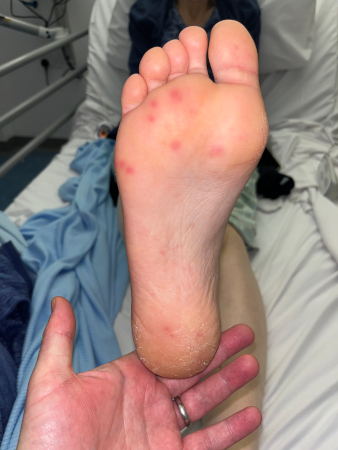 Janeway lesions