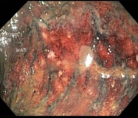 Colonoscopy: denudation of colonic mucosa