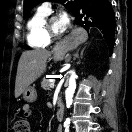Angiotomografia: trombo agudo da artéria mesentérica superior