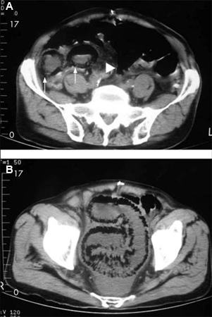 Homem de 84 anos que apresenta sintomas sugestivos de doença intestinal isquêmica: (A) Tomografia computadorizada (TC) abdominal que revela uma formação de ar circunferencial maciça e em forma de faixas como pneumatose intestinal (setas) e edema pronunciado da gordura mesentérica (ponta de seta) ao redor das alças intestinais necrosadas; (B) Outra secção da TC abdominal mostrando pneumatose segmentar longa do intestino delgado