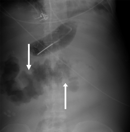 Radiografia abdominal simples: demonstra espessamento acentuado da parede do cólon transversal compatível com o achado do sinal de impressão digital (setas brancas)