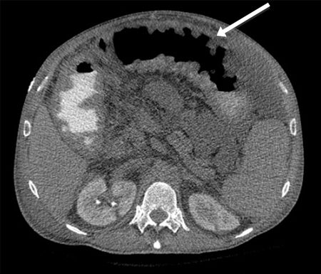 Tomografia computadorizada (TC): espessamento circunferencial da parede do cólon transverso; as setas brancas mostram o sinal de impressão digital