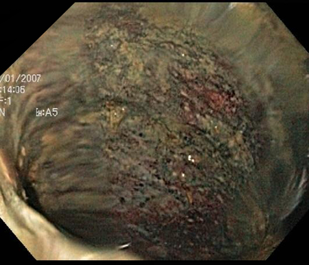 Colonoscopia: descamação da mucosa e cólon provavelmente não viável