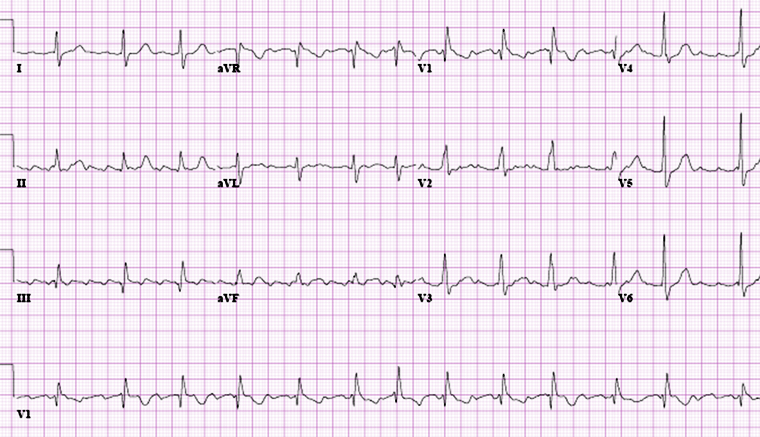 Atypical flutter with right bundle branch block