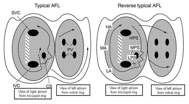 Left panel: atrial activation in typical atrial flutter (AFL). Right panel: activation in reverse typical AFL. The atria are represented schematically in a left anterior oblique view, from the tricuspid (left) and mitral rings. The endocardium is shaded and the openings of the superior (SVC) and inferior vena cava (IVC), coronary sinus (CS), and pulmonary veins (PV) are shown. The direction of activation is shown by arrows. Dashed areas mark approximate location of zones of slow conduction and block. Lettering on the right-hand panel marks the low (LPS), mid (MPS), and high (HPS) posteroseptal wall, respectively