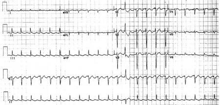 Reverse typical atrial flutter