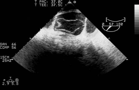 Trans-oesophageal echocardiography (transverse aortic section) showing a circumferential dissection of the ascending aorta in a 30-year-old patient with features of Marfan's syndrome