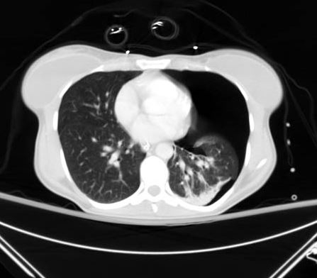 CT scan showing large left-sided pneumothorax