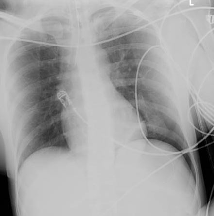 CXR depicting the same pneumothorax as shown on CT