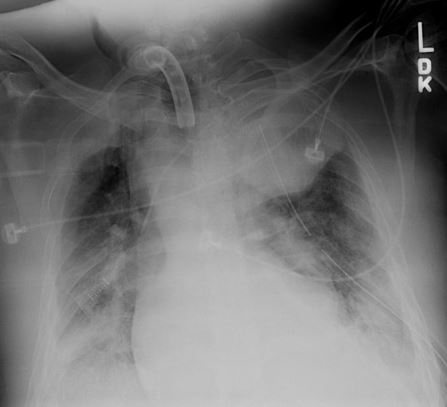 Anteroposterior CXR multiple left-sided rib fractures with chest tube in place